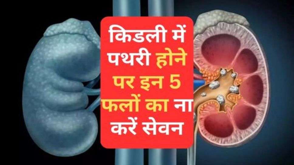 Kidney Stones : किडली में पथरी होने पर इन 5 फलों का ना करें सेवन, हो सकती है तकलीफ