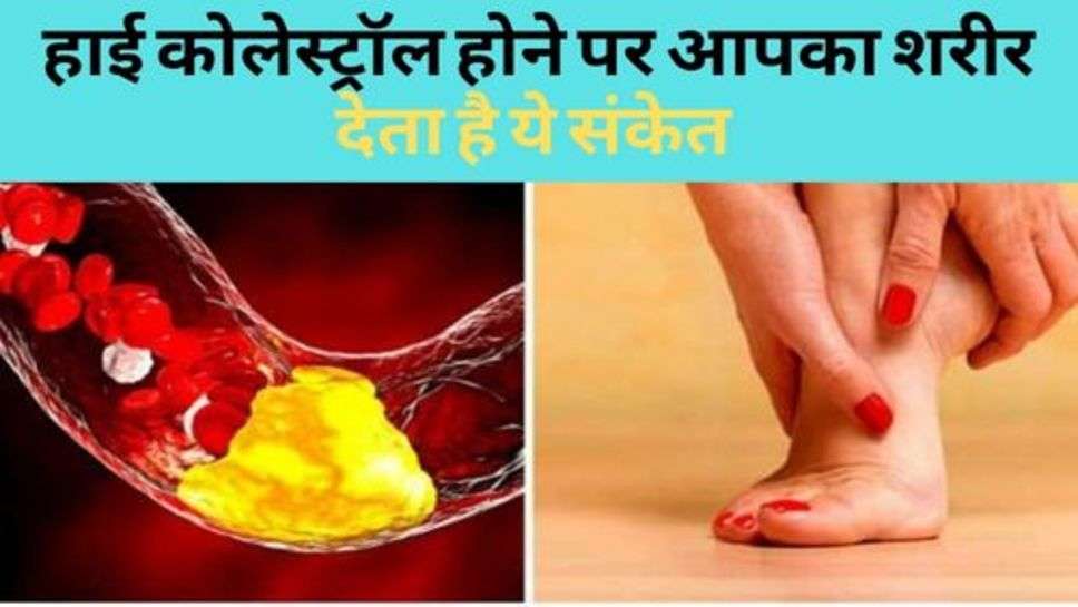 Health News : हाई कोलेस्ट्रॉल होने पर आपका शरीर देता है ये संकेत