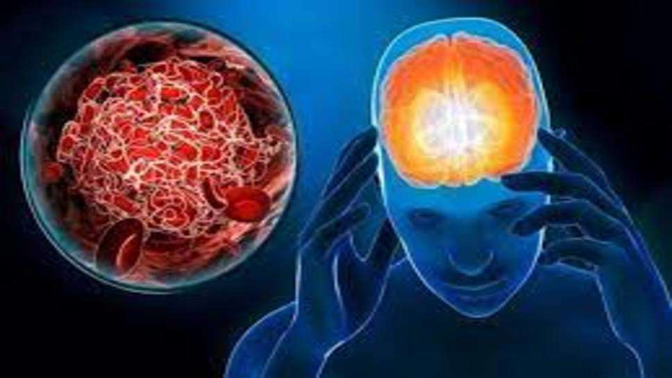 Brain Stroke Cause : ब्रेन स्ट्रोक का कारण बनती हैं ये 3 तीन चीज, आज ही करें परहेज