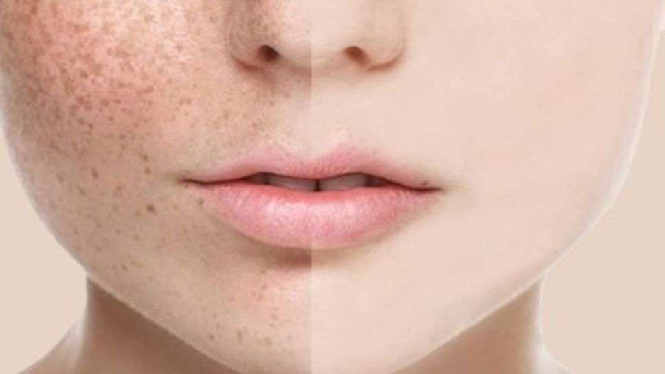 Skin Care : चेहरे पर झाइयों को कम करने के लिए इस्तेमाल करें बस एक ये चीज, घर में ही है उपलब्ध